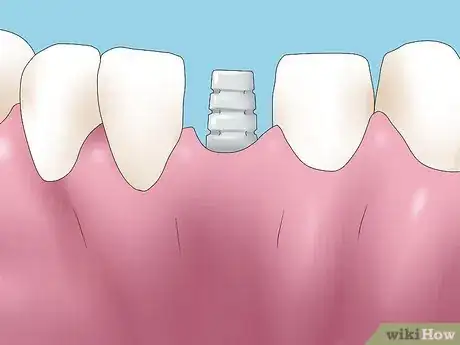 Image titled Reverse Dental Bone Loss Step 1