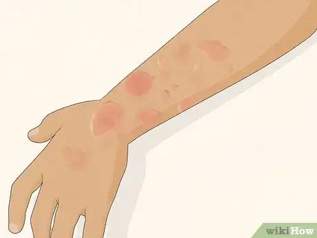 Image titled Recognize Hives (Rash) Step 2