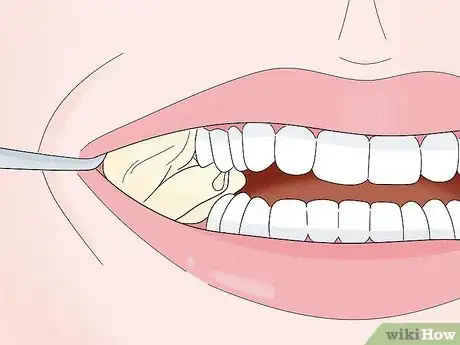 Image titled Recover after Wisdom Teeth Surgery Step 5