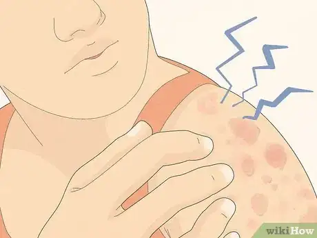 Image titled Recognize Hives (Rash) Step 1