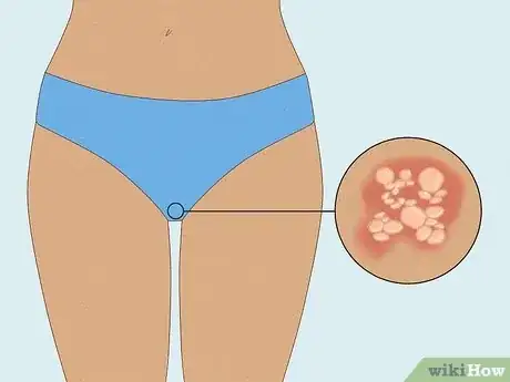 Image titled Get Rid of a Rash Between Your Legs Step 12