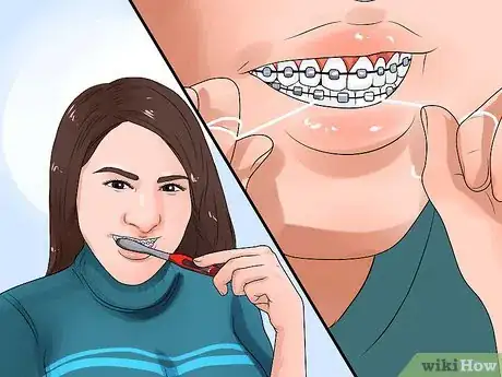 Image titled Clean Teeth With Braces Step 8