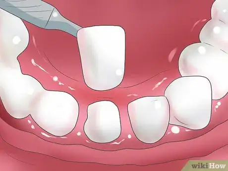 Image titled Bleach Your Teeth Step 12