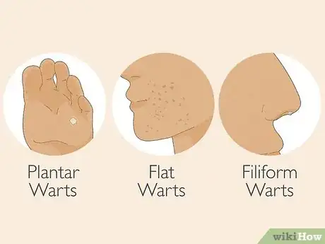 Image titled Identify Warts Step 2