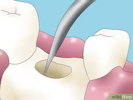 Image titled Reverse Dental Bone Loss Step 5