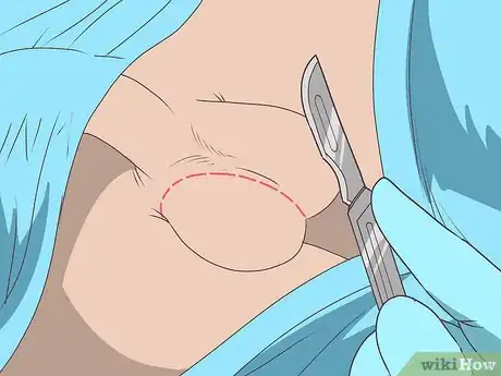 Image titled Diagnose Testicular Cancer Step 13