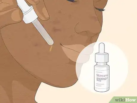 Image titled Get Rid of Cystic Acne Scars Step 7