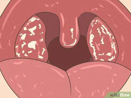 Image titled Differentiate Bacterial Tonsillitis and Viral Tonsillitis Step 7