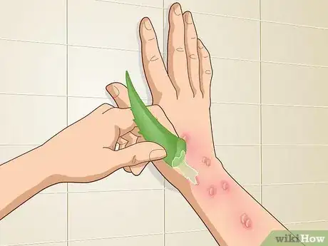 Image titled Get Rid of Poison Oak Rash Step 9