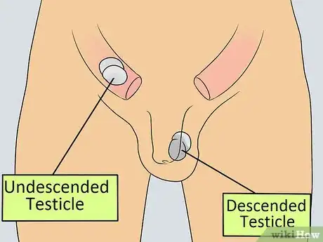 Image titled Recognize Male Infertility Step 14