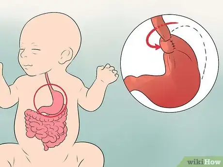 Image titled Treat Acid Reflux in Newborns Step 11