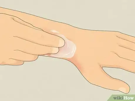 Image titled Use Aloe Vera to Treat Burns Step 3