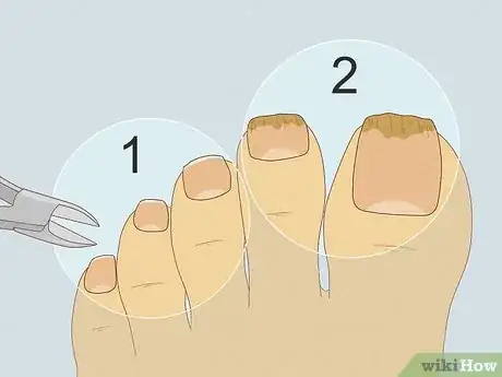 Image titled Trim Toenails with Fungus Step 8