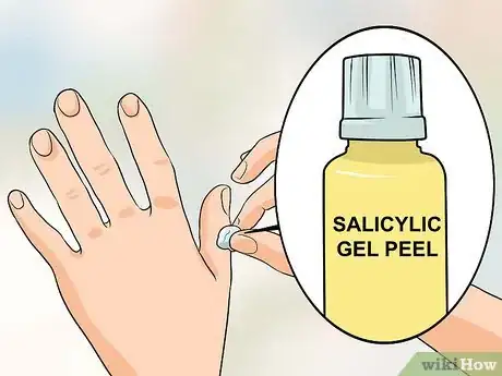 Image titled Get Rid of Warts on Fingers Step 1