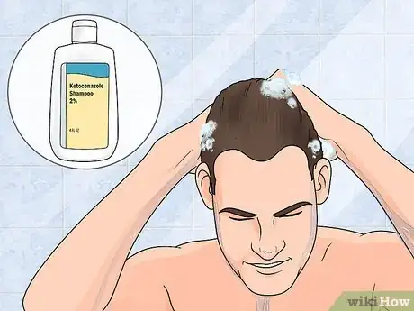 Image titled Treat Male Pattern Hair Loss Step 1