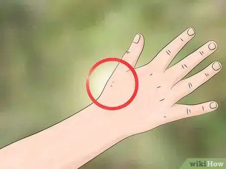 Image titled Identify and Treat Black Widow Spider Bites Step 1