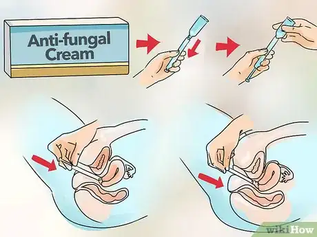 Image titled Cure Vaginal Infections Without Using Medications Step 27