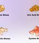 Dissolve Kidney Stones