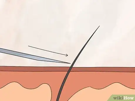 Image titled Remove an Ingrown Hair Step 11