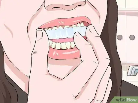 Image titled Use Teeth Whitening Gel Step 5