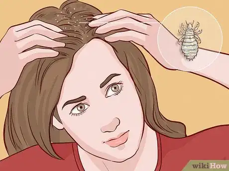 Image titled Get Rid of Lice Step 5