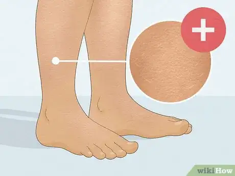 Image titled Heal Dry Skin on Legs Step 17