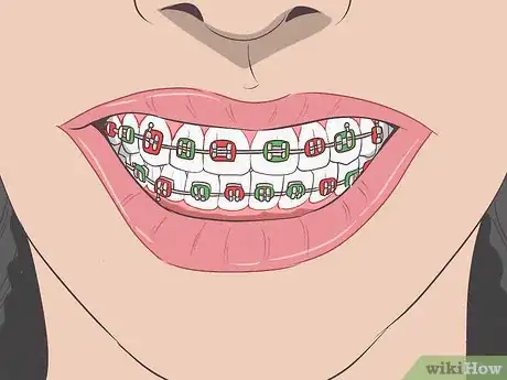 Image titled Hide Braces Step 10