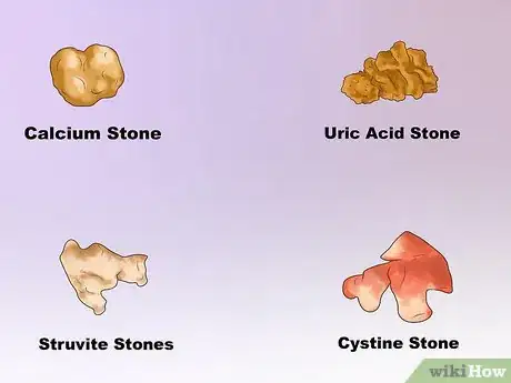 Image titled Dissolve Kidney Stones Step 3