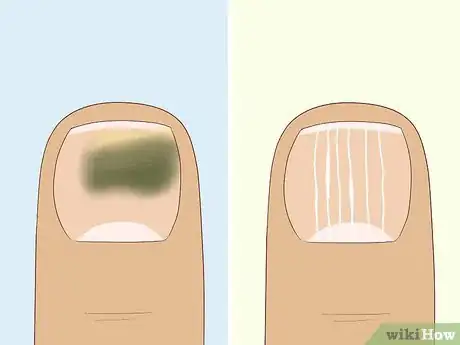 Image titled Heal Damaged Nails Step 1