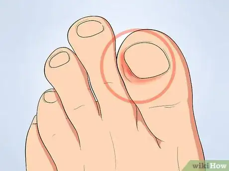 Image titled Tell if an Ingrown Toenail Is Infected Step 1