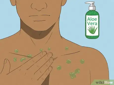 Image titled Get Rid of a Mosquito Bite Step 6