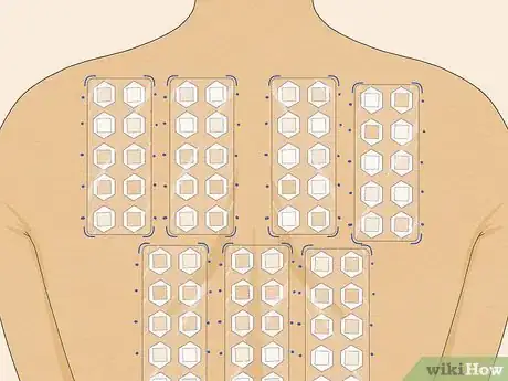 Image titled Read Allergy Skin Test Results Step 6