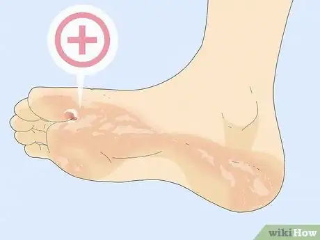 Image titled Get Rid of Foot Fungus Step 5