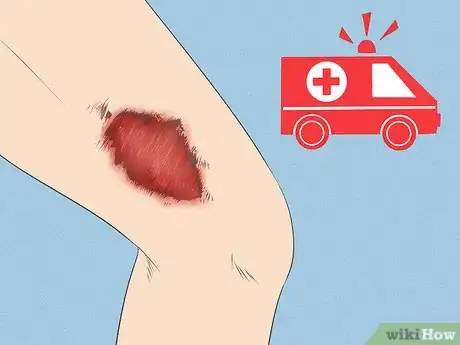 Image titled Clean Road Rash Step 1