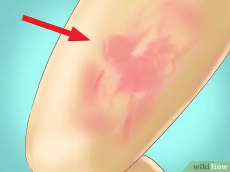 Image titled Recognize Hives (Urticaria) Step 2