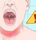 Get Rid of a Sore Throat Quickly