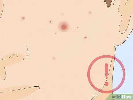 Image titled Pop a Pimple Step 3