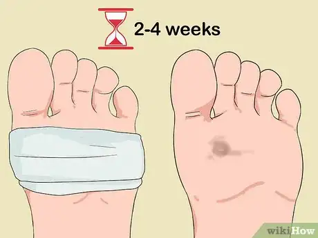 Image titled Get a Wart Surgically Removed Step 10