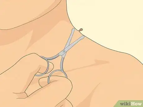 Image titled Get Rid of Skin Tags Step 10