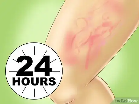 Image titled Recognize Hives (Urticaria) Step 4