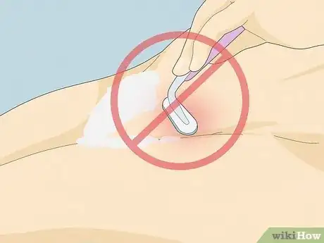 Image titled Get Rid of Razor Bumps in the Bikini Area Step 10