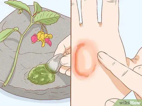 Image titled Get Rid of Poison Ivy Rashes Step 6