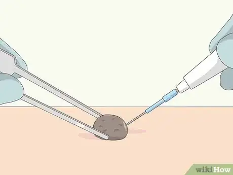 Image titled Remove Moles Quickly Step 6