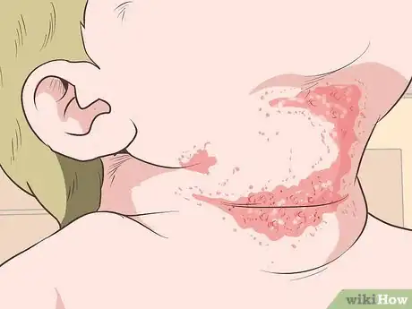 Image titled Identify and Treat Different Types of Diaper Rash Step 7