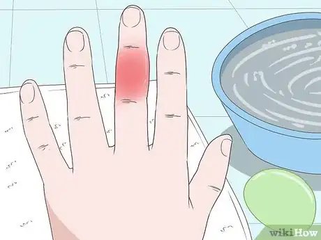 Image titled Cure an Infected Finger Step 1