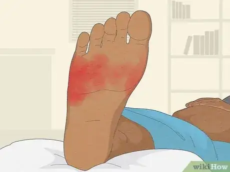 Image titled Use Aloe Vera to Treat Burns Step 8