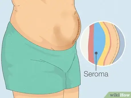 Image titled Help a Seroma Reabsorb Step 1