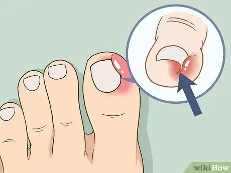 Image titled Soak an Ingrown Toenail Step 9