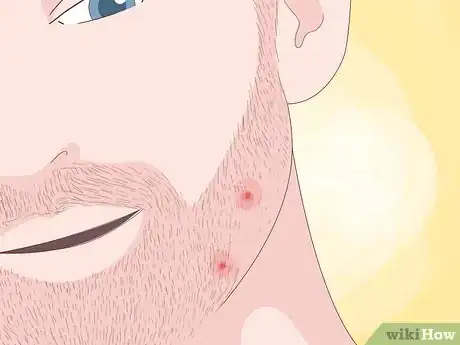 Image titled Spot Ingrown Hairs Step 3