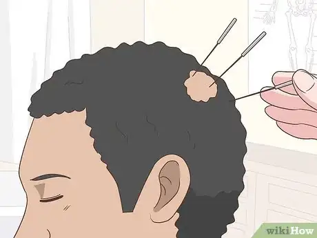 Image titled Treat Alopecia Step 10